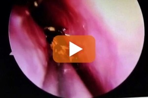 Nel video lo scarafaggio finito nel cranio di una donna in India