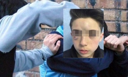 Pestato a 13 anni per strada, genitori decidono di postare foto dei lividi: "Non devono passarla liscia"