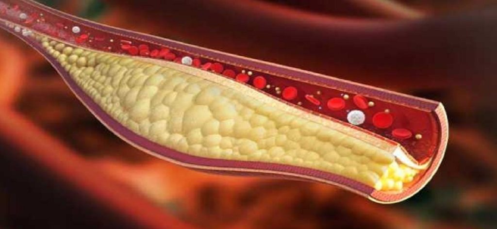 colesterolo-napoli-cura-alto-università