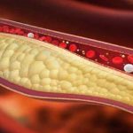 colesterolo-napoli-cura-alto-università