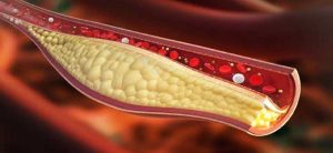 colesterolo-napoli-cura-alto-università