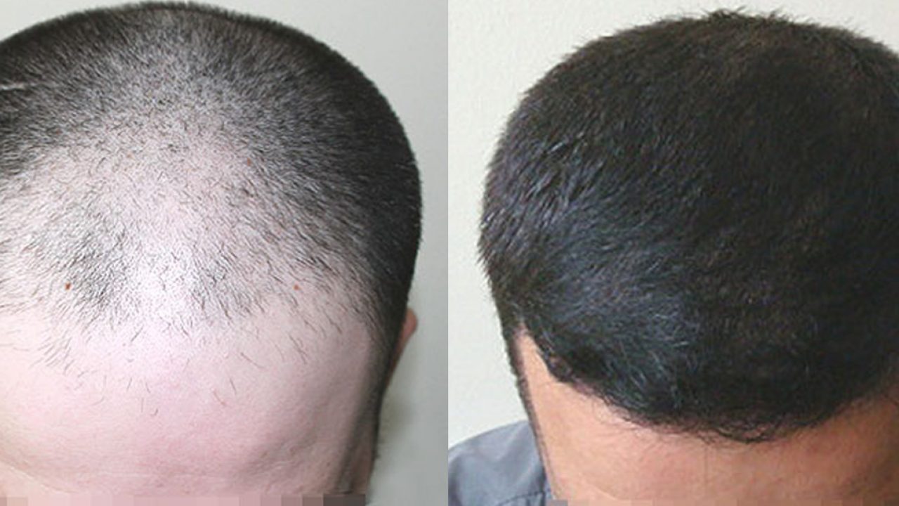 17+ Amorevole Trapianto Capelli Uomo Immagini