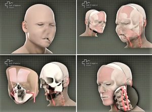 trapianto_facciale (2)