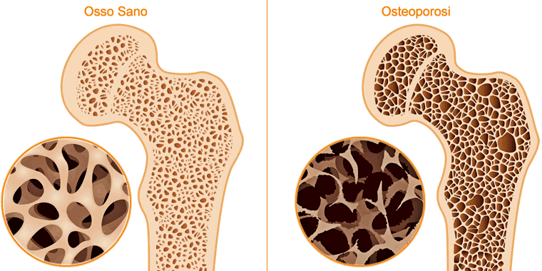 Osteoporosi: arriva Vitamina D orodispersibile e in capsule molli