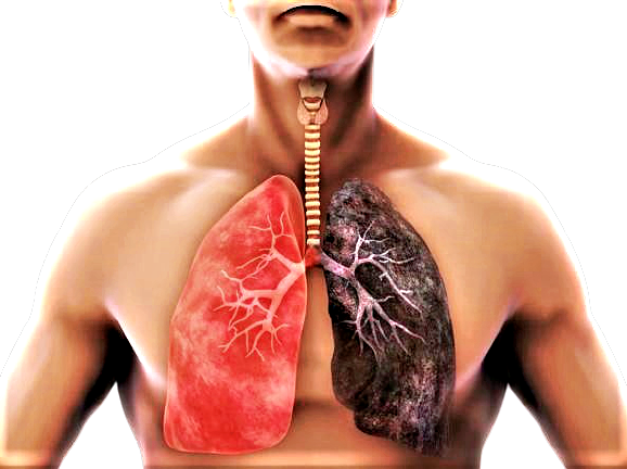 Fumo e tumore al polmone, rischio malattia non è uguale per tutti
