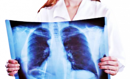 Con screening cancro polmone riduzione mortalità del 35%