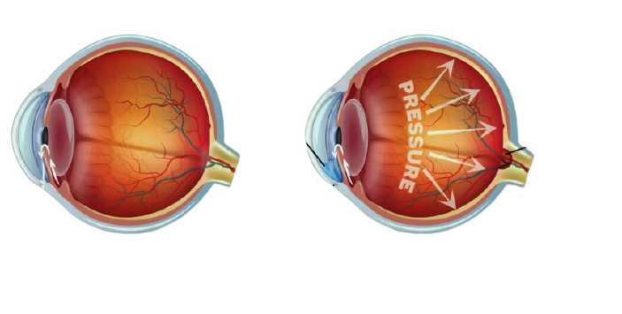 Glaucoma nemico silenziso che “ruba” la vista
