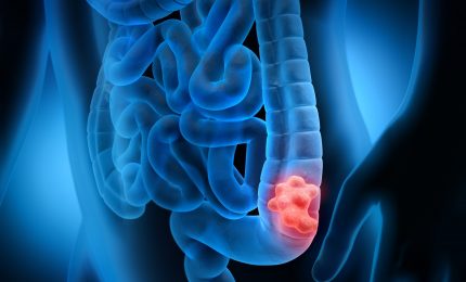 Tumore colon: "stanate" cellule responsabili delle recidive