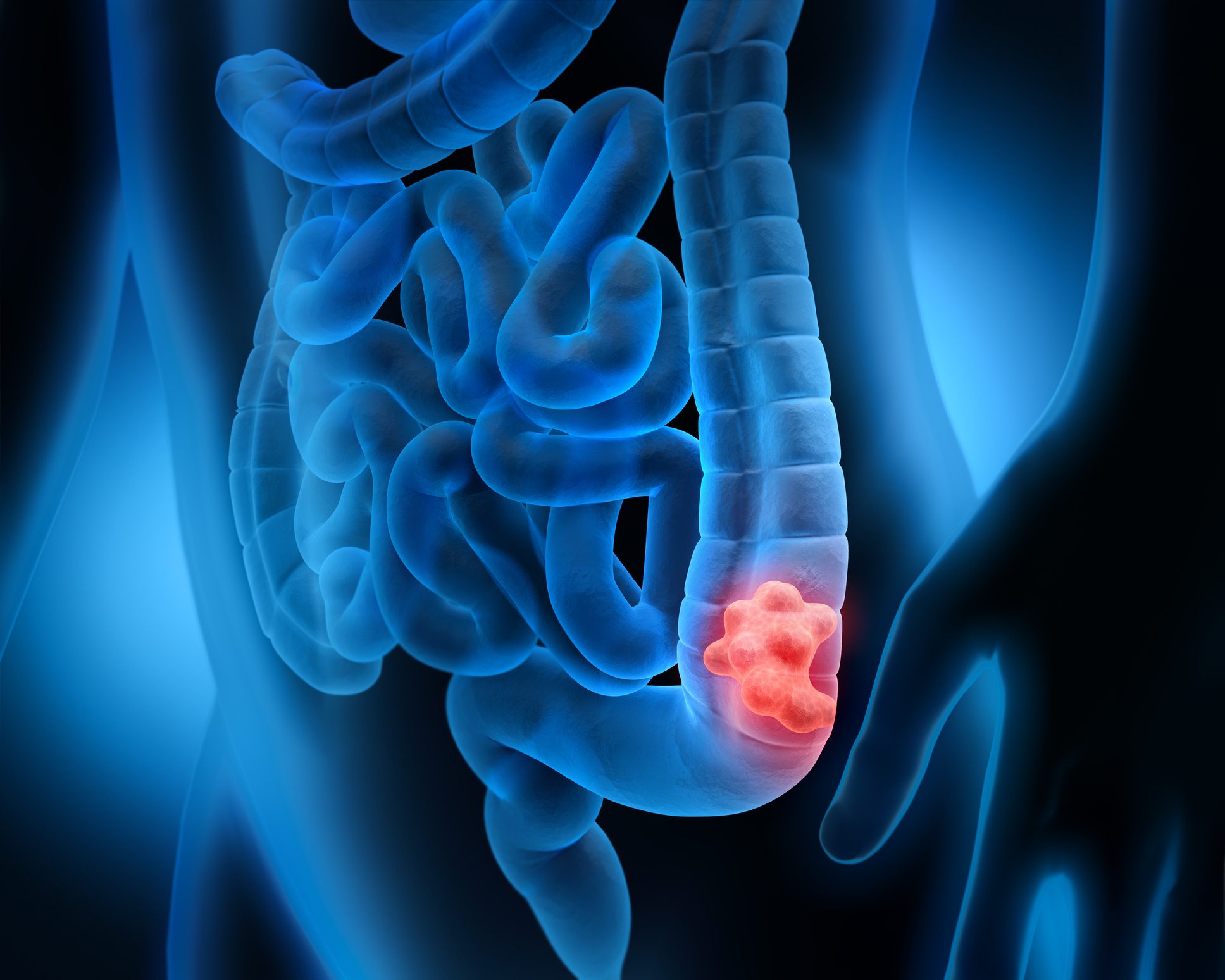 Tumore colon: “stanate” cellule responsabili delle recidive