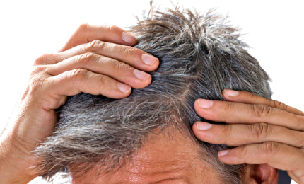 Effetti del Covid-19, 30% dei positivi soffrirà di caduta di capelli