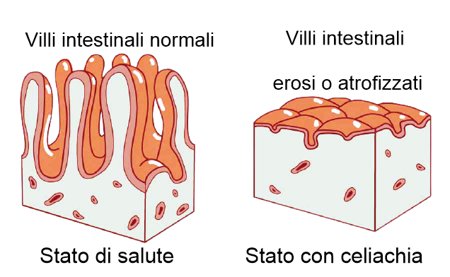 Celiachia, indagine più semplice in bimbi asintomatici