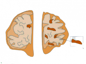 Morbo_di_alzheimer_700x525-removebg-preview