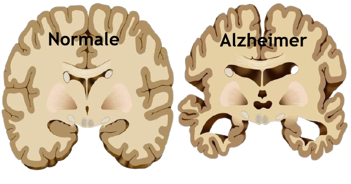 “Intervenire sugli stili di vita può prevenire l’Alzheimer”