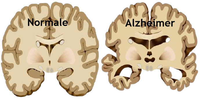 Alzheimer: proteina protegge nucleo cellulare da malformazioni