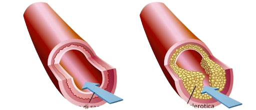 malattie-cardiovascolari-in-arrivo-i-nuovi-scudi-salva-cuore-removebg-preview