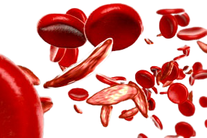 Arriva in Italia una nuova terapia per l’anemia falciforme