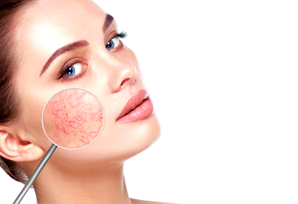 Dermatologia, aprile è il mese internazionale della rosacea