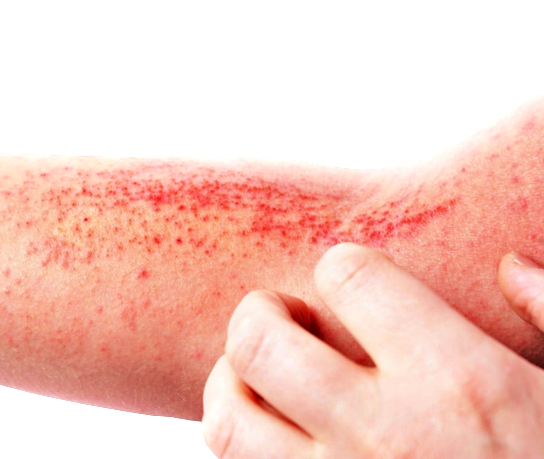Contro la dermatite atopica, “Rimettiti in gioco”