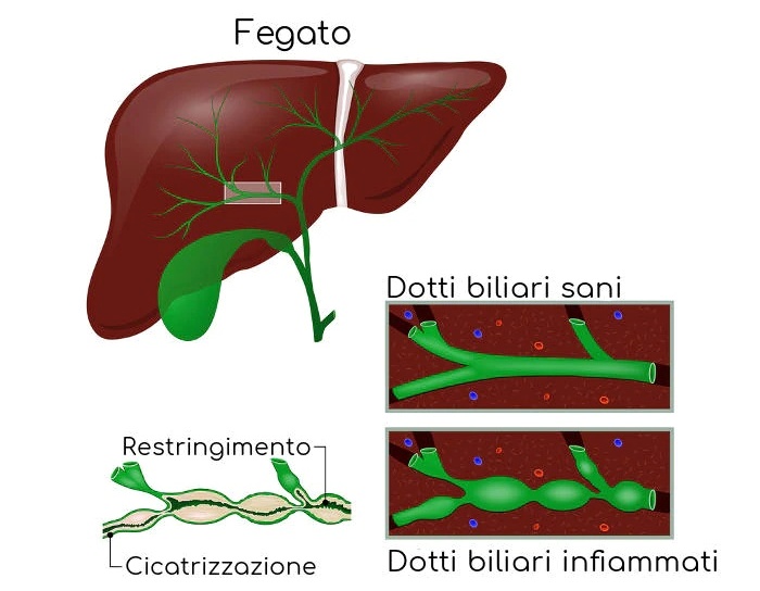 Colangite biliare primitiva, 18 mila le persone affette da Pbc