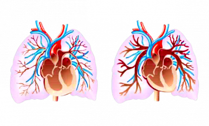 Impianto in arteria polmonare controlla cuore a distanza
