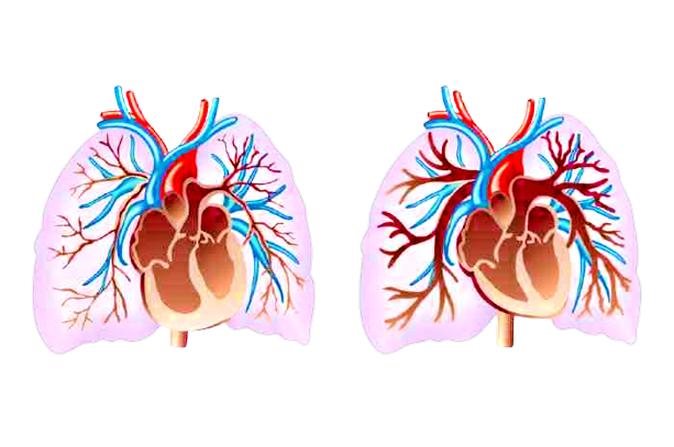 Impianto in arteria polmonare controlla cuore a distanza