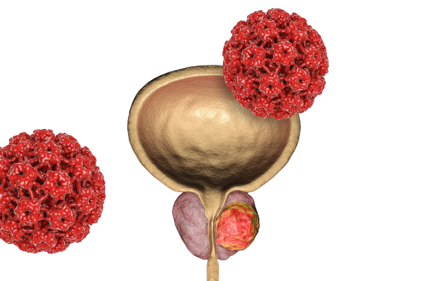 Tumore alla prostata, si ampliano le possibilità di cura