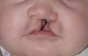 Labiopalatoschisi-e-Palatoschisi