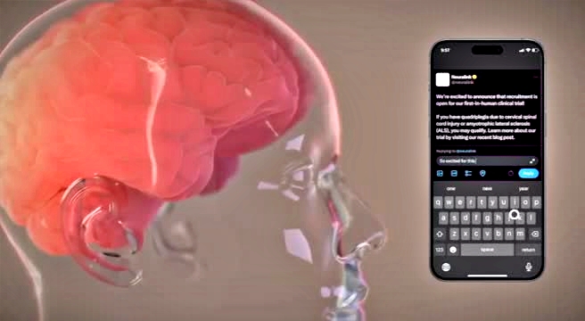 Neuralink ha installato in un essere umano Telepathy, primo impianto cerebrale